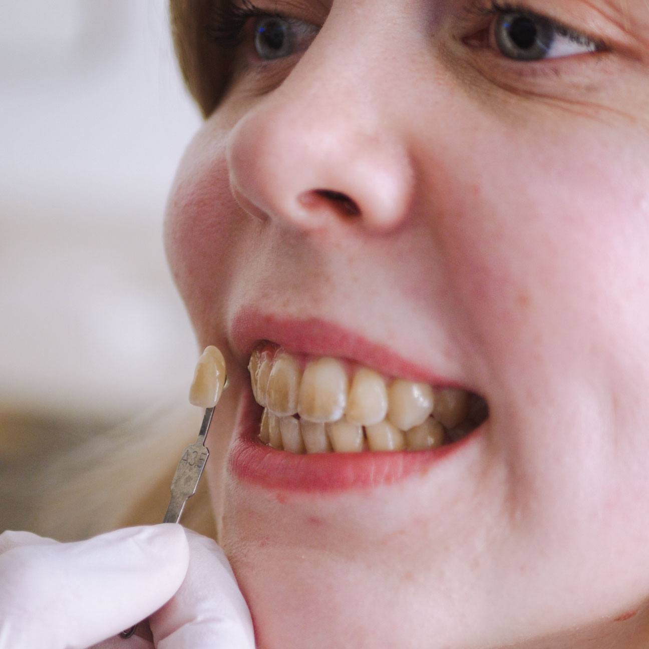 KAN MISFARVEDE TÆNDER BLIVE HVIDE IGEN? Svaret er ganske enkelt ja. Uanset om du har interne eller eksterne misfarvninger, kan du få lavet en tandblegning. På den måde kan du få et hvidt smil igen. Hus Falkoner Tandlægerne og Nørreport Tandlægerne kan du få foretaget en tandblegning, hvor du opnår et smukt og effektivt resultat, uden at skade tænderne.